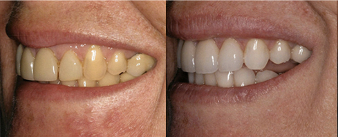 In House Full Service Dental Laboratory before after elle jordan In House Full Service Dental Laboratory