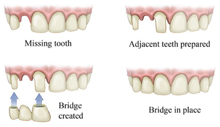 dental bridges